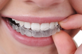 Invisalign Platinum Provider - Dentista Milano Rizza s.r.l.